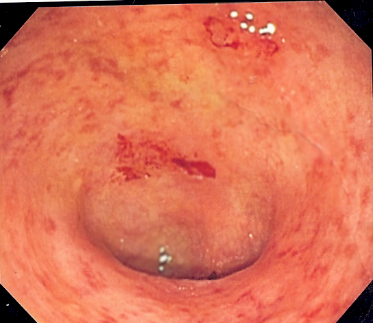 FDA phê duyệt mirikizumab, một liệu pháp điều trị duy trì và tấn công đầy hứa hẹn cho bệnh viêm loét đại tràng