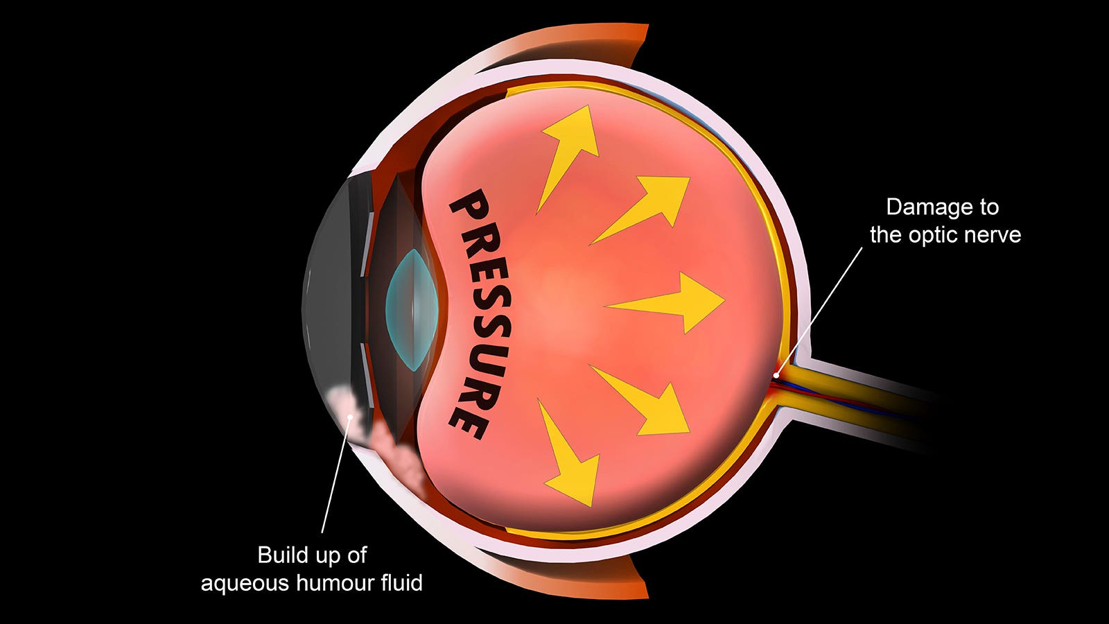 Higher Polygenic Risk Score Tied to Increased Risk for Glaucoma