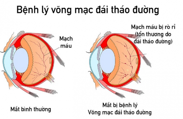 Xét nghiệm chẩn đoán bệnh võng mạc tiểu đường