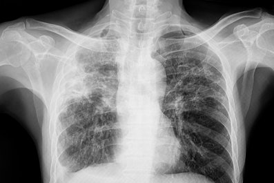 Tuberculosis Cases Are Surging in California