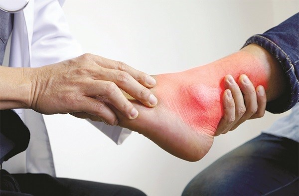 Những triệu chứng của bệnh gout và cách chữa trị