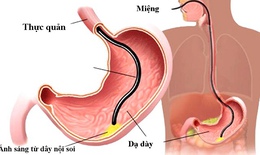 Nội soi tiêu hóa cho trẻ cần chú ý những gì?