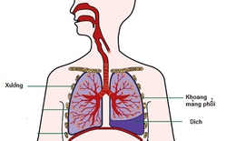 Tràn dịch màng phổi: Nguyên nhân, biểu hiện và điều trị