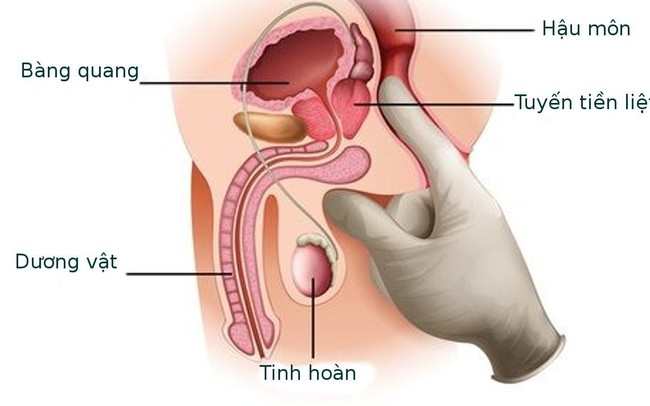 Câu hỏi thường gặp liên quan đến ung thư tuyến tiền liệt