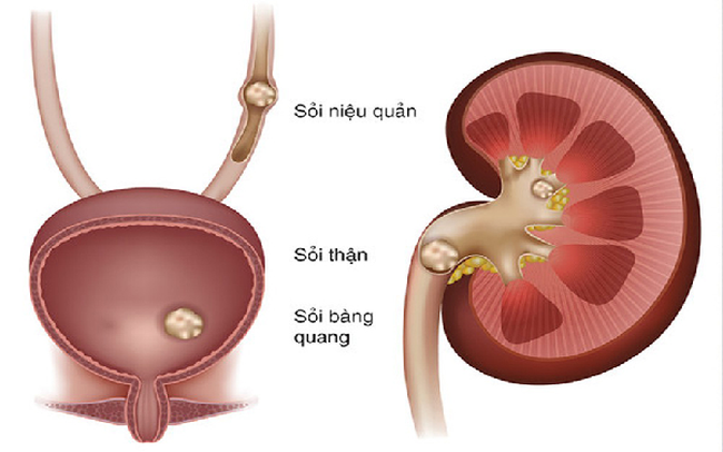 Sỏi tiết niệu: Nguyên nhân, triệu chứng, cách điều trị và phòng bệnh