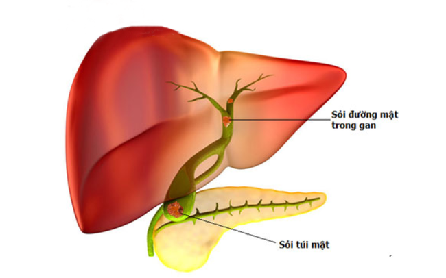 Biến chứng nguy hiểm của sỏi đường mật trong gan