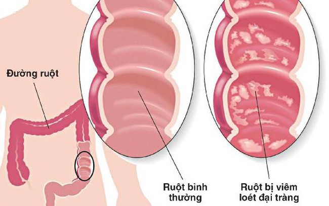 Thuốc mới điều trị viêm loét đại tràng