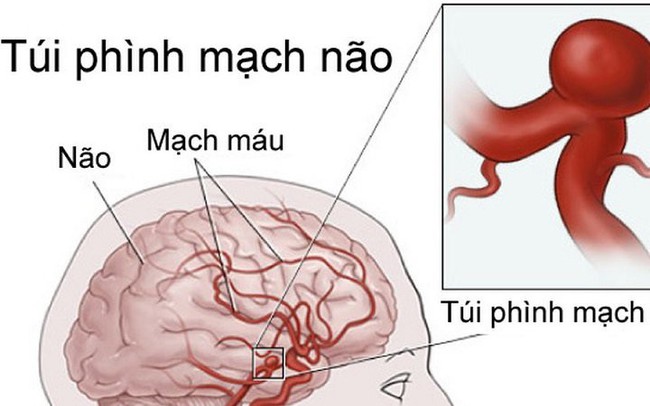 Phình mạch máu não phát hiện bằng cách nào?