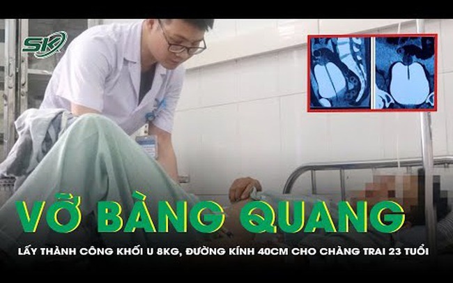 Vỡ bàng quang do uống bia quá mức, phải phẫu thuật gấp