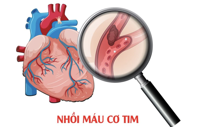 Lưu ý cho người từng bị nhồi máu cơ tim để tránh tái phát bệnh