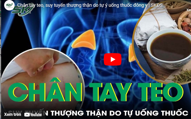 Chân tay teo, suy tuyến thượng thận do tự ý uống thuốc đông y