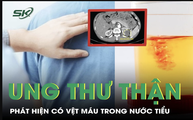 Bàng hoàng phát hiện ung thư thận từ dấu hiệu lạ trong nước tiểu