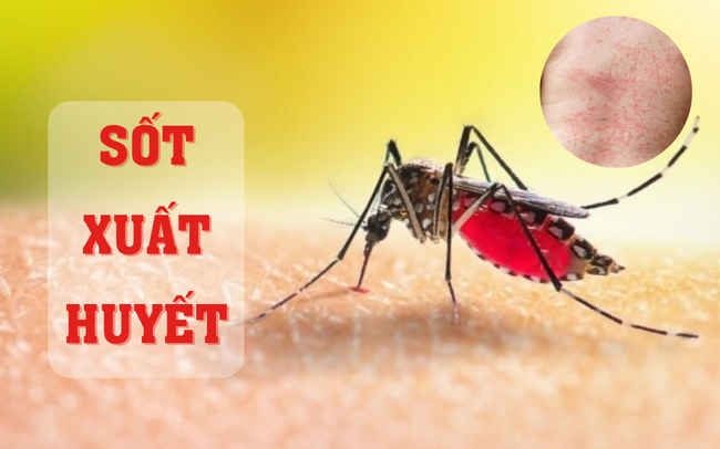 Sốt xuất huyết, sốt virus và sốt phát ban: Phân biệt như thế nào?