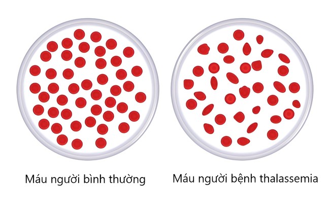 Vì sao cần xét nghiệm gen Thalassemia?