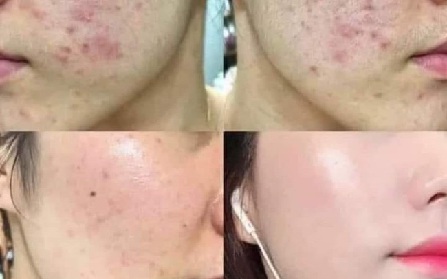 Điều trị mụn trứng cá dùng thuốc gì nhanh khỏi?