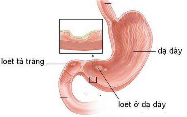 Viêm loét dạ dày có thành ung thư không?