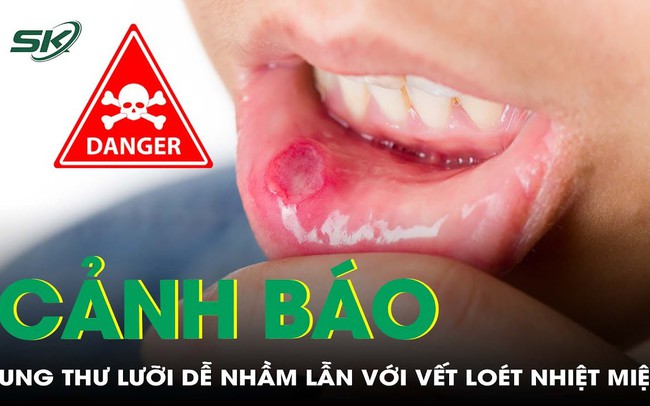 Ung thư bờ lưỡi dễ bị nhầm lẫn với vết loét nhiệt miệng