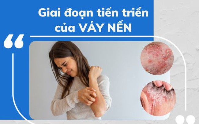 Các triệu chứng của bệnh vảy nến bạn nên biết