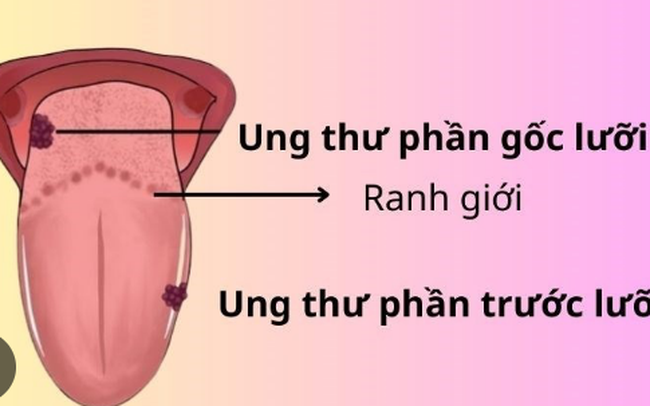 Người bệnh ung thư lưỡi nên tập luyện như thế nào?