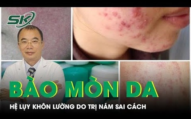 Cảnh báo da bị bào mòn vì trị nám sai cách