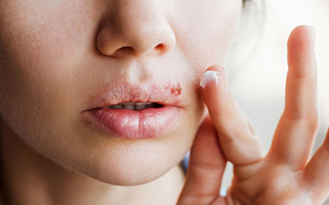 Những điều cần biết về mụn rộp Herpes