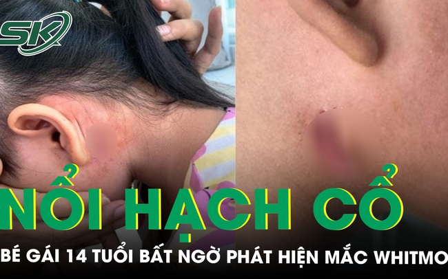 Phát hiện nữ sinh mắc Whitmore nổi hạch ở vùng cổ