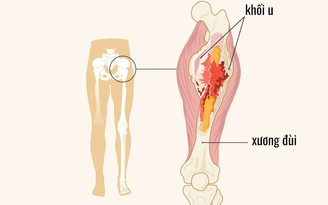 Dấu hiệu cảnh báo ung thư xương ở trẻ cha mẹ cần lưu ý