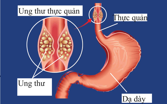 Các loại thuốc điều trị ung thư thực quản