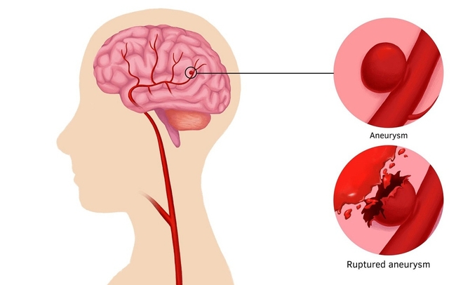 Đau đầu đột ngột coi chừng phình động mạch não