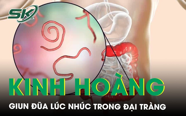 Kinh hoàng hàng chục con giun đũa dài hơn 10cm lúc nhúc trong đại tràng người đàn ông