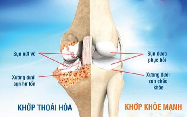 Bài thuốc làm chậm thoái hóa khớp