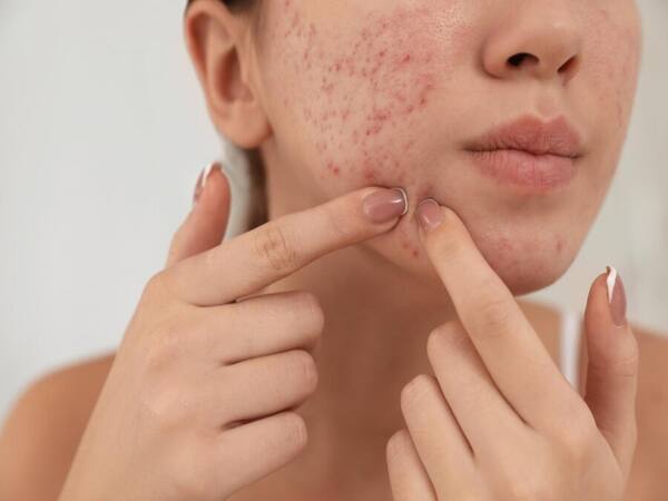 Sự hiện diện của Acne trên những mặt cụ thể cho thấy gì về sức khỏe?