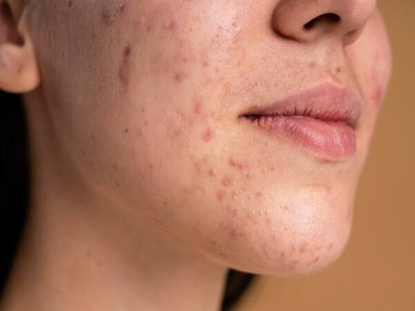 Cancer-Causing Chemical Can Form In Some Acne Treatment Products, Lab Warns