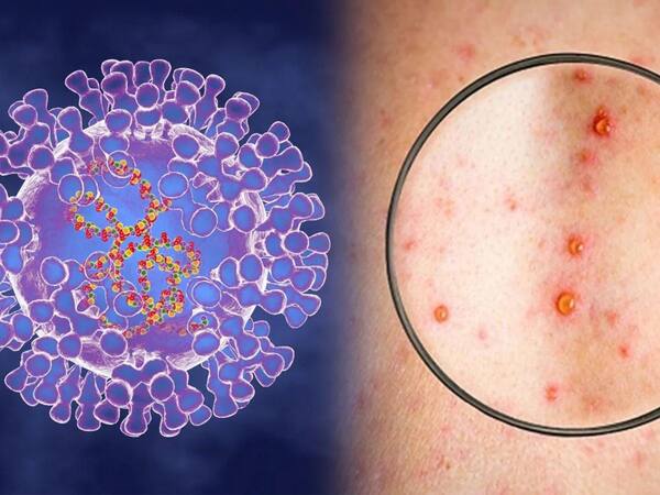 Mpox Outbreak in India: AIIMS Giao thức điều trị những bệnh nhân bị cáo ở Delhi 10 điểm