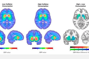 Cà phê có thể làm giảm nồng độ dopamine ở những người được chẩn đoán mắc bệnh Parkinson không?