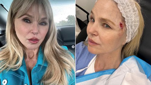 Christie Brinkley's skin cancer diagnosis prompts doctor to list three warning symptoms