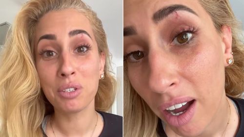 Stacey Solomon tiết lộ vết thương mắt đen sau tai nạn kinh hoàng ở Cotage Pickle