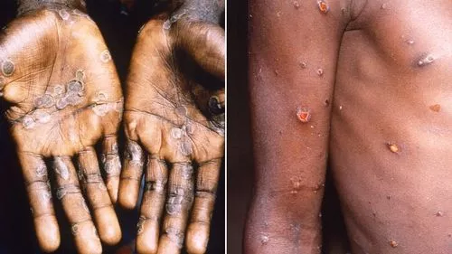 Các nhà khoa học của Mpox làm nguội lạnh dự đoán bùng phát dịch toàn cầu mới sau khi "phát triển liên tục" '