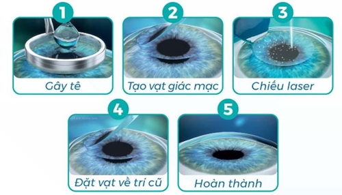 Tìm hiểu về phương pháp phẫu thuật Femto Lasik