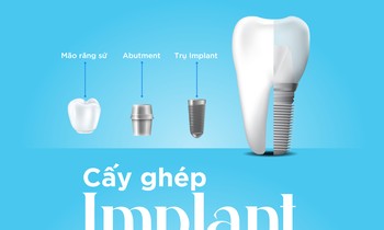 Công nghệ cấy ghép Implant hiện đại tại Nha khoa Fine Dental