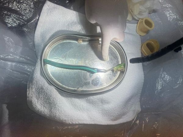 Toothbrush removed from Vietnamese woman’s stomach