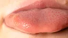 What You Need to Know About Thrush on Your Lips