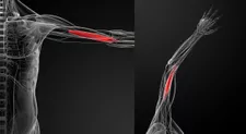 Cơ bắp Brachialis được phẫu thuật