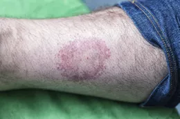 Erythema Migrans là gì?