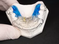 The Pros and Cons of a Removable Retainer