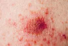 Is Basal Cell Skin Cancer Serious?