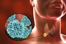 Overview of Papillary Thyroid Cancer