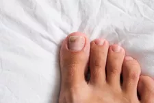 What Are the Different Types of Toenail Fungus?