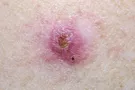 Basal Cell Carcinoma—A Common Type of Skin Cancer