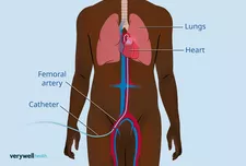 Một thử nghiệm chụp X-quang mạch máu cho thấy gì